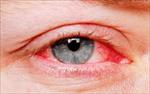پاورپوینت-بیماریهای-التهابی-چشم