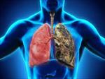 پاورپوینت-بيماريهاي-شغلي-ريه-occupational-lung-disease