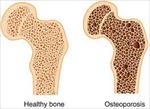 پاورپوینت-osteoporosis-پوکی-استخوان