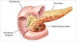 پاورپوینت-پانکراتیت-pancreatitis