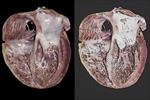 پاورپوینت-کاردیومیوپاتی-cardiomyopathy